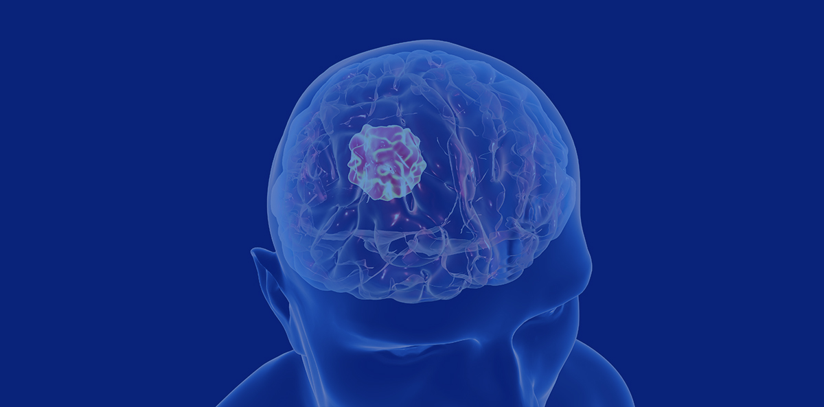 brain tumour treatment